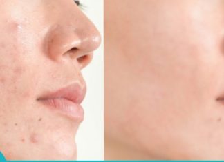 ნაწიბურების მოცილება სახლის პირობებში