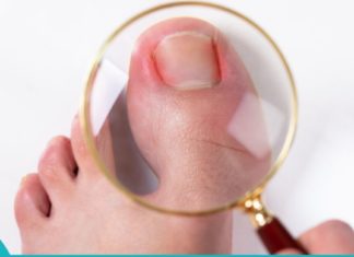 ჩაზრდილი ფრჩხილის მკურნალობის მეთოდები