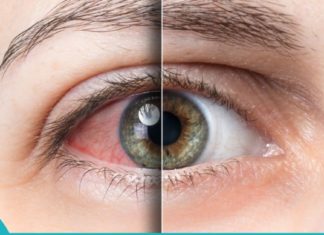 Როგორ ვუმკურნალოთ მშრალი თვალის სინდრომს?