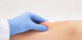 როგორ მოვიცილოთ ლიპომა ხალხური მეთოდით