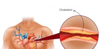 გთავაზობთ 10 მეთოდს, რომელთა დახმარებით ქოლესტერინის დონეს გააკონტროლებთ.