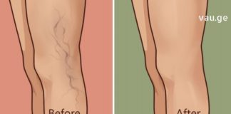 ამ მეთოდით ვარიკოზული ვენების მკურნალობა სახლში გაგიმარტივდებათ