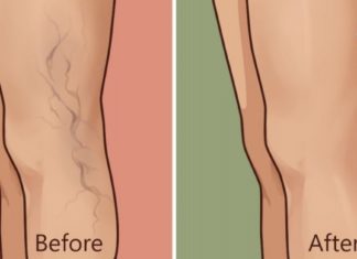 ამ მეთოდით ვარიკოზული ვენების მკურნალობა სახლში გაგიმარტივდებათ