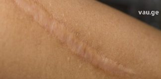 ნაიარევის მოცილება ხალხური მეთოდებით