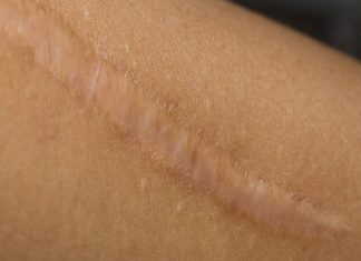 ნაიარევის მოცილება ხალხური მეთოდებით