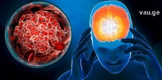 თრომბის ნიშნების ცოდნა აუცილებელია