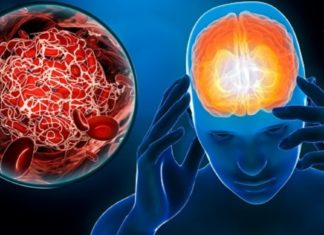 თრომბის ნიშნების ცოდნა აუცილებელია