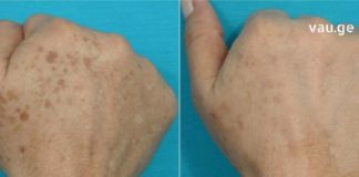 პიგმენტური ლაქების გაღიავება სახლის პირობებში მარტივი და ხელმისაწვდომია