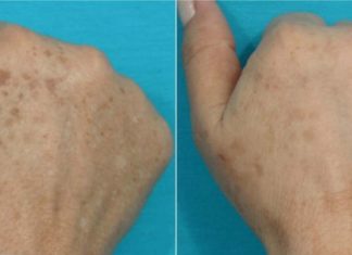 პიგმენტური ლაქების გაღიავება სახლის პირობებში მარტივი და ხელმისაწვდომია