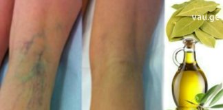 დაფნის ზეთის წყალობით თქვენ საბოლოოდ მოერევით ვარიკოზული ვენების პრობლემებს