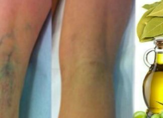 დაფნის ზეთის წყალობით თქვენ საბოლოოდ მოერევით ვარიკოზული ვენების პრობლემებს