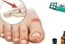 გათავისუფლდით პოდაგრასგან იოდის და ასპირინის დახმარებით!