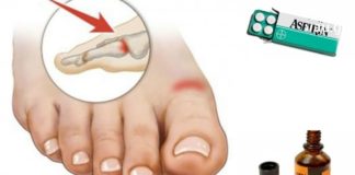 გათავისუფლდით პოდაგრასგან იოდის და ასპირინის დახმარებით!