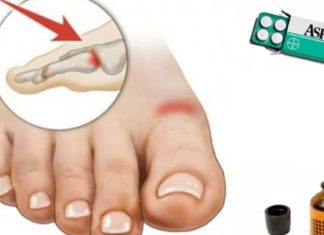 გათავისუფლდით პოდაგრასგან იოდის და ასპირინის დახმარებით!