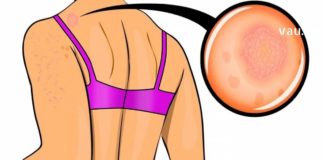 როგორ მოვიცილოთ ზურგზე მტკივნეული და უსიამოვნო გამონაყარი?