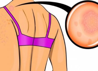 როგორ მოვიცილოთ ზურგზე მტკივნეული და უსიამოვნო გამონაყარი?