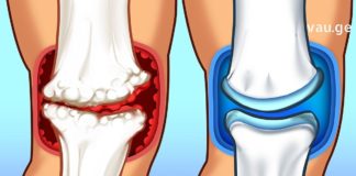 ამ მეთოდით გიცდიათ ძვლების და სახსრების მორჩენა?