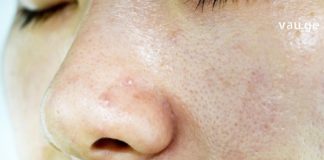 აი რა იწვევს კანის გაცხიმიანებას