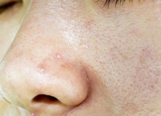 აი რა იწვევს კანის გაცხიმიანებას