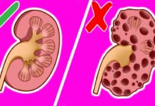 როგორ გამოვდევნოთ თირკმელებიდან კენჭები 15 დღეში? ეს საოცარი მასალა დაგეხმარებათ ამაში!