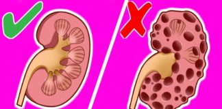 როგორ გამოვდევნოთ თირკმელებიდან კენჭები 15 დღეში? ეს საოცარი მასალა დაგეხმარებათ ამაში!