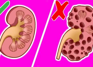 როგორ გამოვდევნოთ თირკმელებიდან კენჭები 15 დღეში? ეს საოცარი მასალა დაგეხმარებათ ამაში!