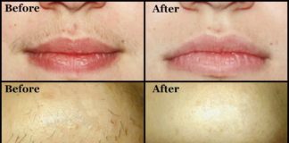 სახიდან არასასურველი თმის სამუდამოდ მოშორების უძველესი მეთოდი შვრით, თაფლით და ლიმონით!