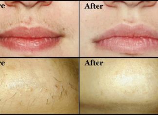 სახიდან არასასურველი თმის სამუდამოდ მოშორების უძველესი მეთოდი შვრით, თაფლით და ლიმონით!