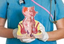 ბუასილის ყველაზე ეფექტური სამკურნალო რეცეფტები