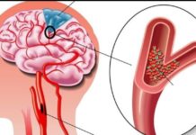 ეს არის ყველაზე ძლიერი რეცეპტი, რომელიც დღის განმავლობაში გაწმენდს სისხლძარღვებს თავის ტვინში!