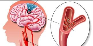 ეს არის ყველაზე ძლიერი რეცეპტი, რომელიც დღის განმავლობაში გაწმენდს სისხლძარღვებს თავის ტვინში!
