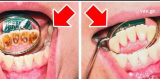 ჩვენ შევაგროვეთ იმ მარტივი მეთოდების ჩამონათვალი, რომლის საშუალებითაც თავად შეძლებთ კბილებიდან კარიესისა და ღრმულების მოშორებას