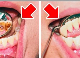 ჩვენ შევაგროვეთ იმ მარტივი მეთოდების ჩამონათვალი, რომლის საშუალებითაც თავად შეძლებთ კბილებიდან კარიესისა და ღრმულების მოშორებას