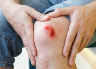 როგორ შევაჩეროთ ჭრილობიდან სისხლდება 10 წამში