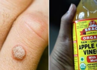 მეჭეჭების მოცილება ყველაზე ეფქტური გზით უმოკლეს დროში