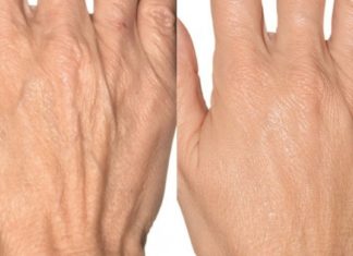 ამ 46 წლის ქალბატონის ხელები გამოყურებოდა ისე როგორც 70 წლის ასაკში, მაგრამ როდესაც ამ საიდუმლო რეცეფტის გამოყენება დაიწყო, ვეღარ ცნობს მის ხელებს.