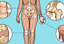 მე ეს შევძელი! თქვენც გამოგივათ. დაამარცხეთ სამუდამოდ მტანჯველი ართრიტი