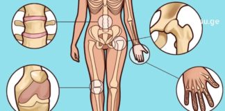 მე ეს შევძელი! თქვენც გამოგივათ. დაამარცხეთ სამუდამოდ მტანჯველი ართრიტი