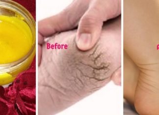 დამსკდარი ქუსლების საოცრად ეფექტური მალამო, რომელიც დამზადებულია ბუნებრივ ინგრედიენტებზე.