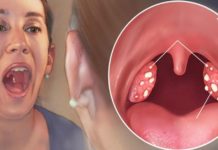 უნიკალური რეცეფტი ანგინის, სინუსიტისა და სხვადასხვა ინფეციების დროს