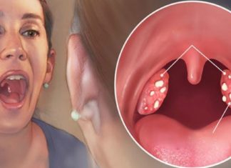 უნიკალური რეცეფტი ანგინის, სინუსიტისა და სხვადასხვა ინფეციების დროს