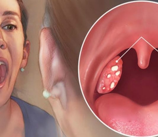 უნიკალური რეცეფტი ანგინის, სინუსიტისა და სხვადასხვა ინფეციების დროს