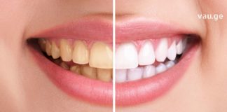 გაითეთრეთ კბილები ამ მეთოდით ყოველგვარი დაზიანების გარეშე