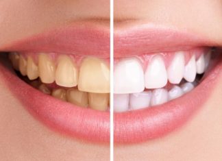 გაითეთრეთ კბილები ამ მეთოდით ყოველგვარი დაზიანების გარეშე