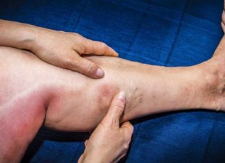 უებარი სამკურნალო ნაყენი თრომბოზისა და ვარიკოზული ვენების დროს. მკურნალობის კიდევ რამდენიმე მარტივი და იაფი რეცეპტი