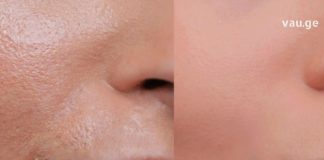 წლების განმავლობაში მტანჯავდა ცხიმიანი კანი. დავისვენე რაც ამ მეთოდებს ვიყენებ ხალხური მედიცინიდან