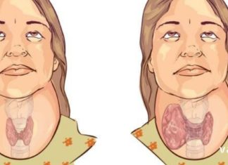 ამ მეთოდით შევძელი ჩიყვის განკურნება