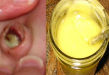 უძლიერესი სამკურნალო საშუალება, რომელსაც ორგანიზმიდან გამოაქვს ჩირქი