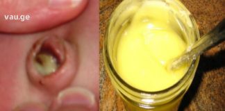 უძლიერესი სამკურნალო საშუალება, რომელსაც ორგანიზმიდან გამოაქვს ჩირქი