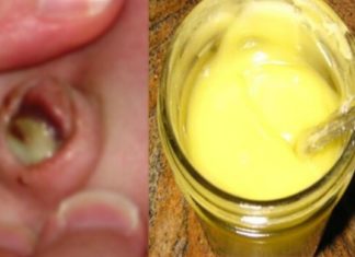 უძლიერესი სამკურნალო საშუალება, რომელსაც ორგანიზმიდან გამოაქვს ჩირქი